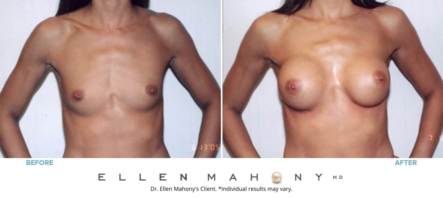 Before and After Image: Case #3097 - front