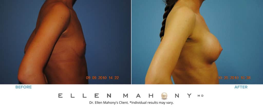 Before and After Image: Case #3102 - right-side