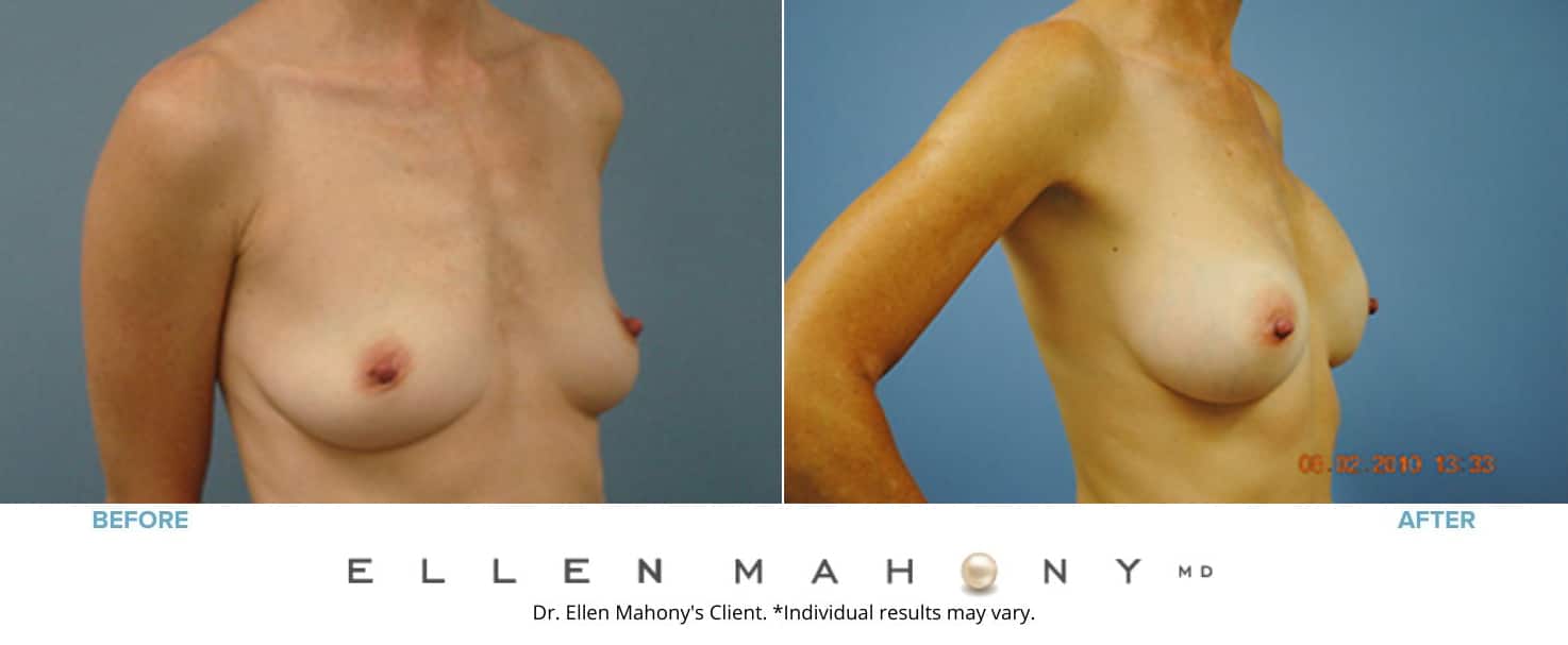 Before and After Image: Case #3109 - right-front-oblique