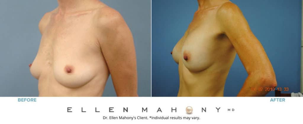 Before and After Image: Case #3109 - left-front-oblique