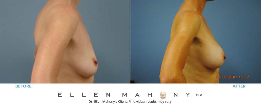 Before and After Image: Case #3109 - right-side