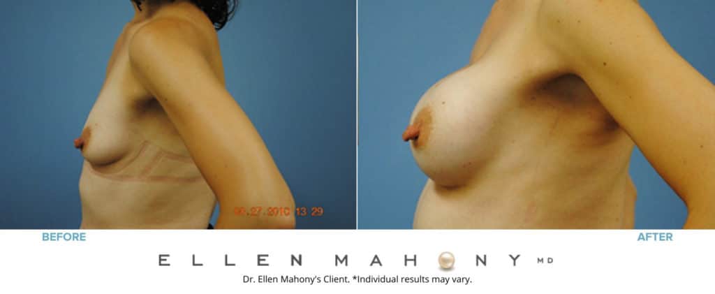 Before and After Image: Case #3116 - left-side