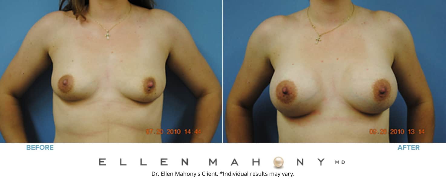 Before and After Image: Case #3123 - front