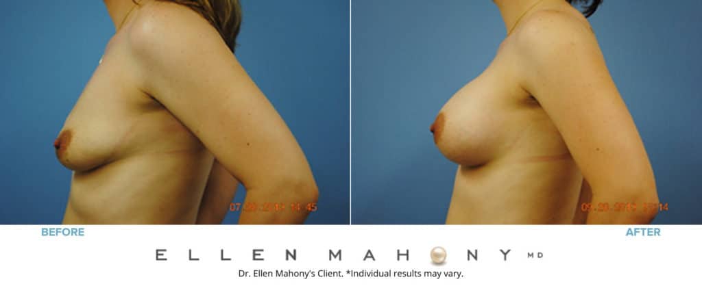 Before and After Image: Case #3123 - left-side