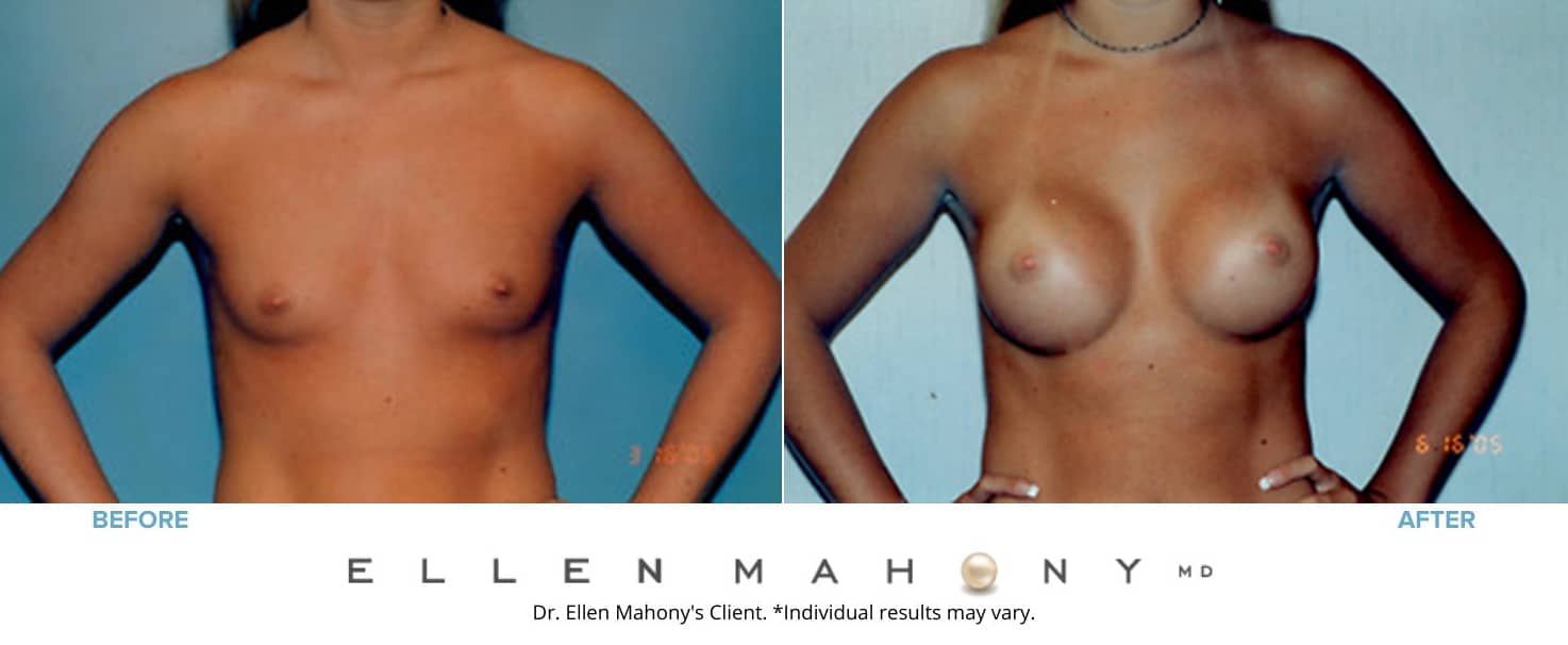 Before and After Image: Case #3130 - front
