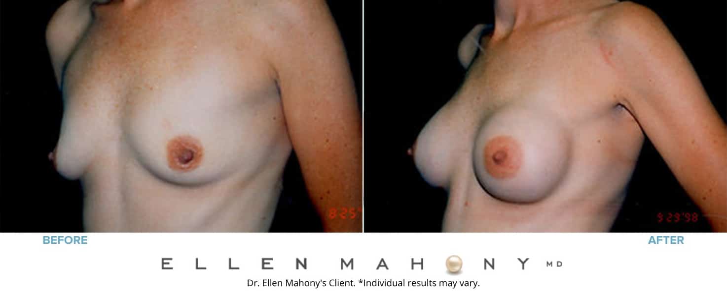 Before and After Image: Case #3133 - left-front-oblique
