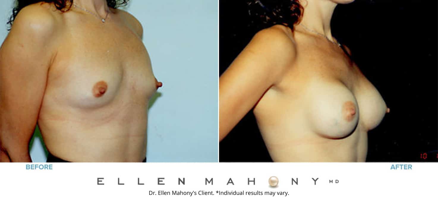 Before and After Image: Case #3136 - right-front-oblique