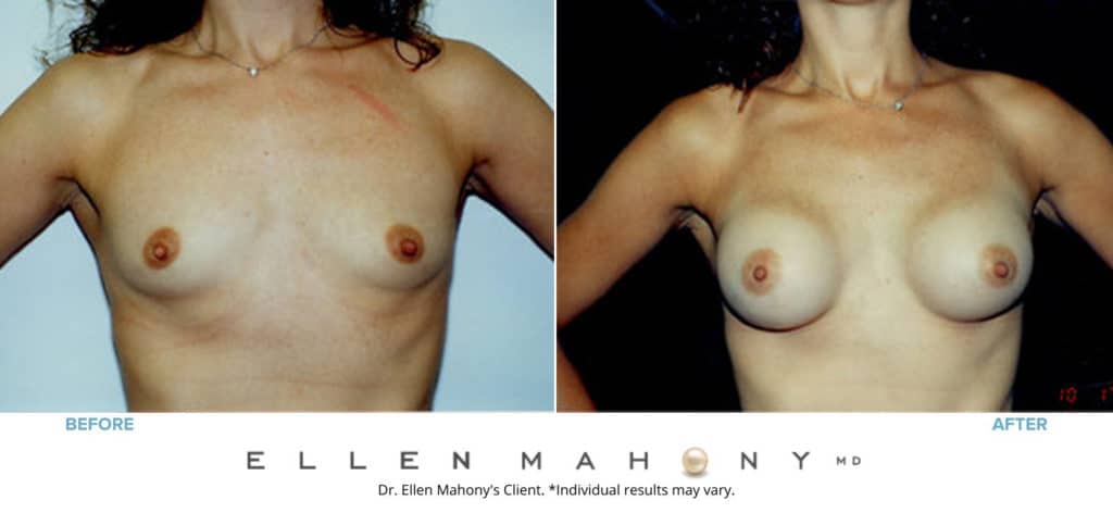 Before and After Image: Case #3136 - front