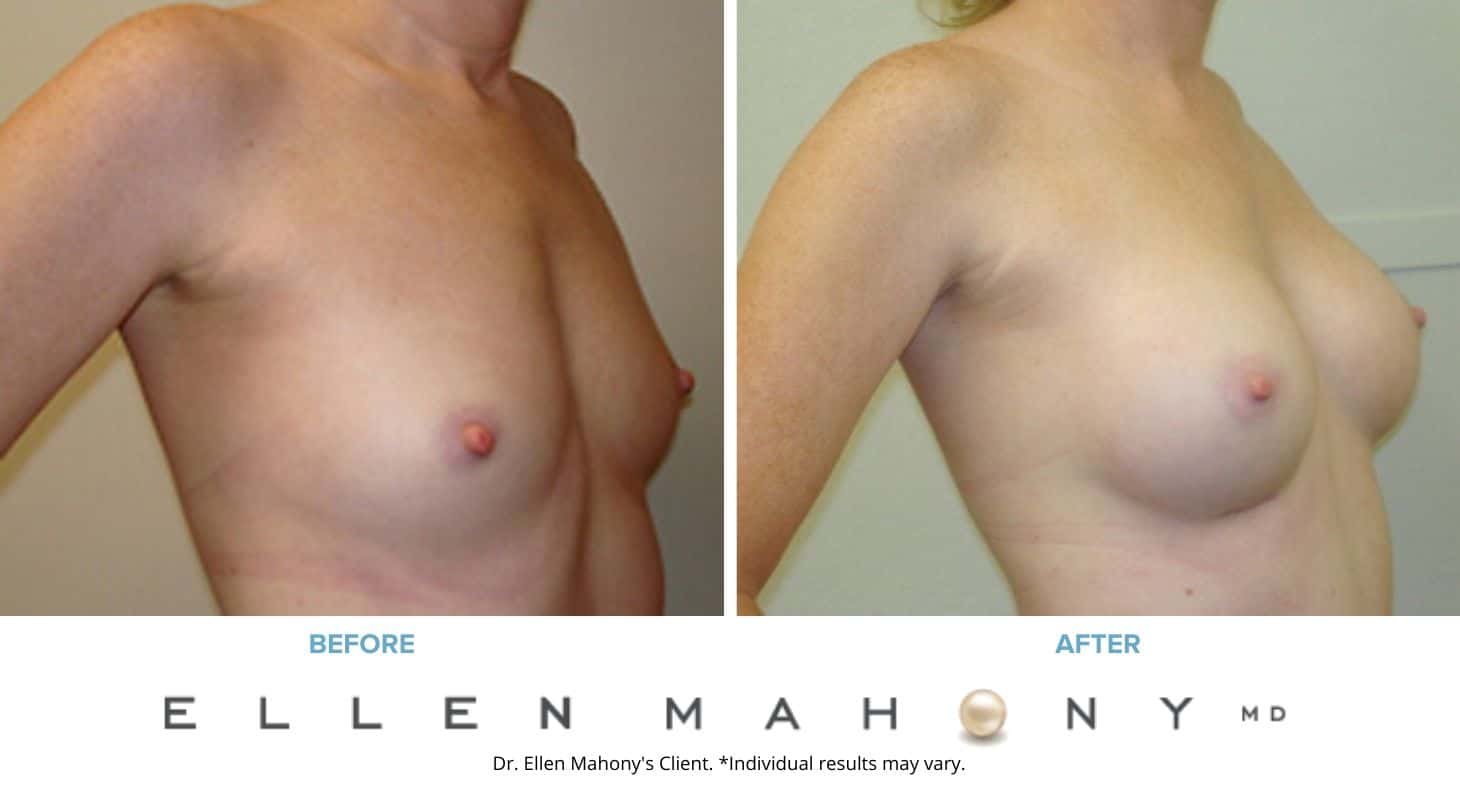Before and After Image: Case #3143 - right-front-oblique