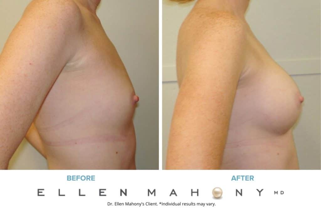 Before and After Image: Case #3143 - right-side