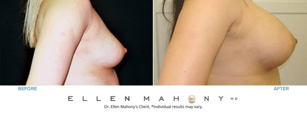 Before and After Image: Case #3148 - right-side