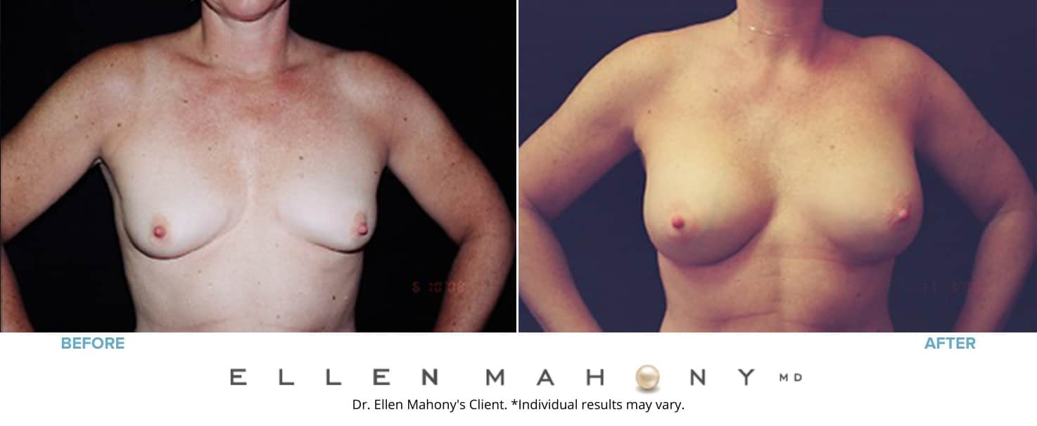 Before and After Image: Case #3153 - front