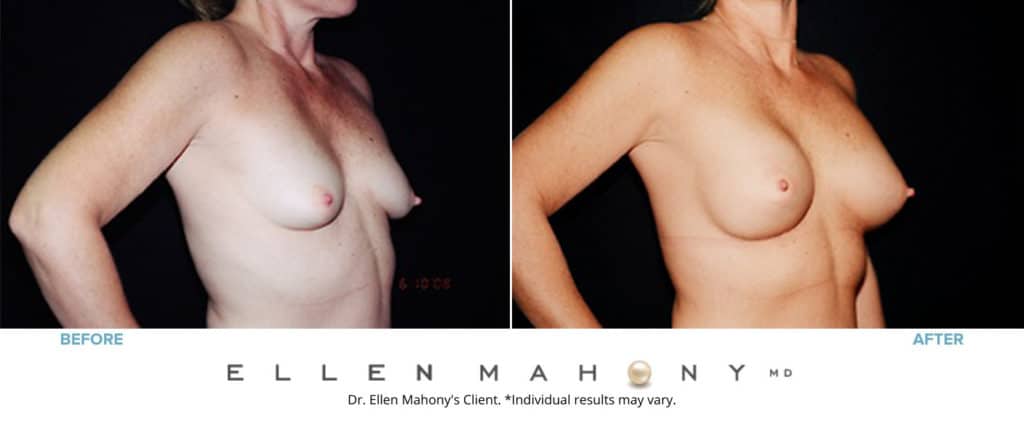Before and After Image: Case #3153 - right-front-oblique