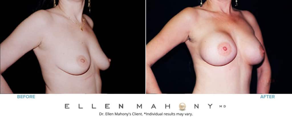Before and After Image: Case #3160 - right-front-oblique