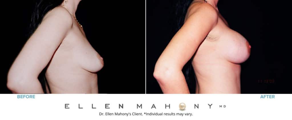 Before and After Image: Case #3160 - right-side