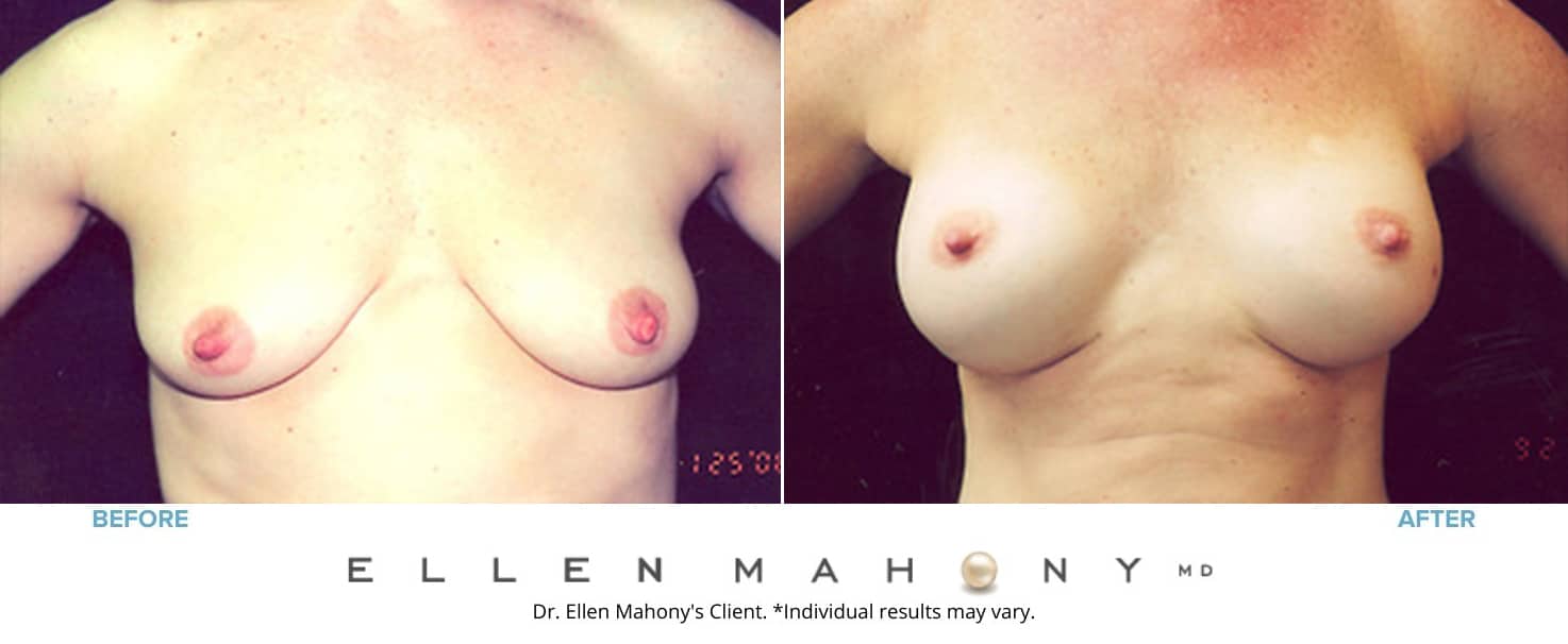 Before and After Image: Case #3174 - front