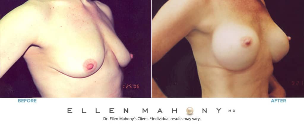 Before and After Image: Case #3174 - right-front-oblique