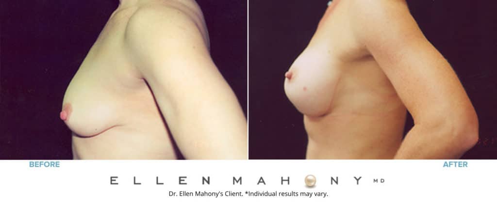 Before and After Image: Case #3174 - left-side
