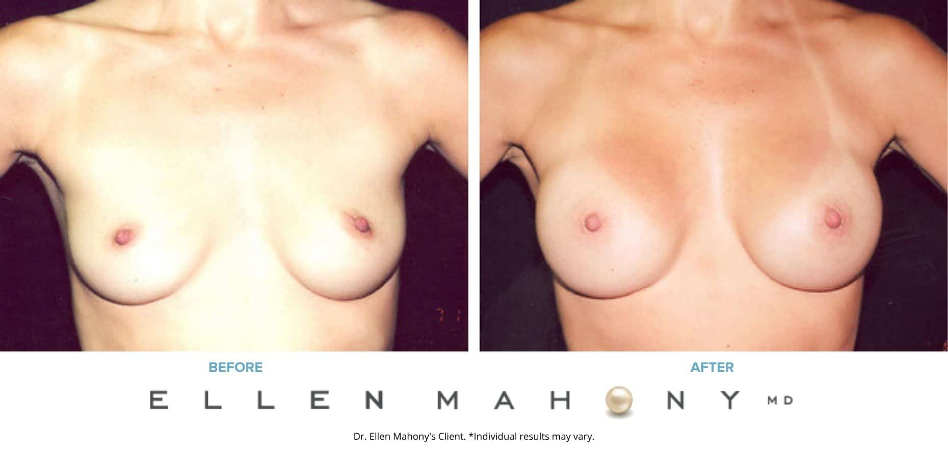 Before and After Image: Case #3181 - front