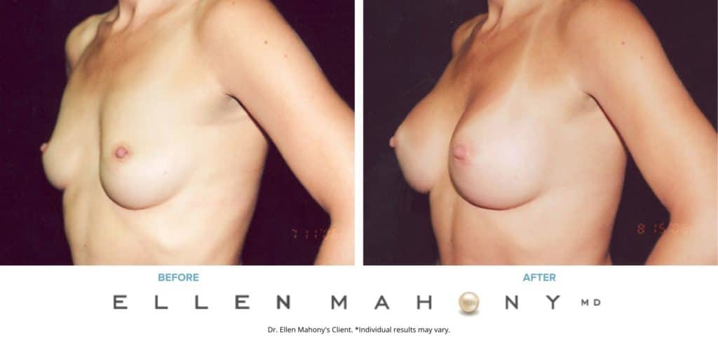 Before and After Image: Case #3181 - left-front-oblique