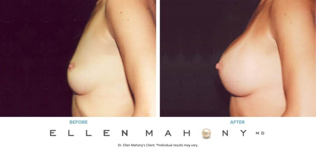 Before and After Image: Case #3181 - left-side