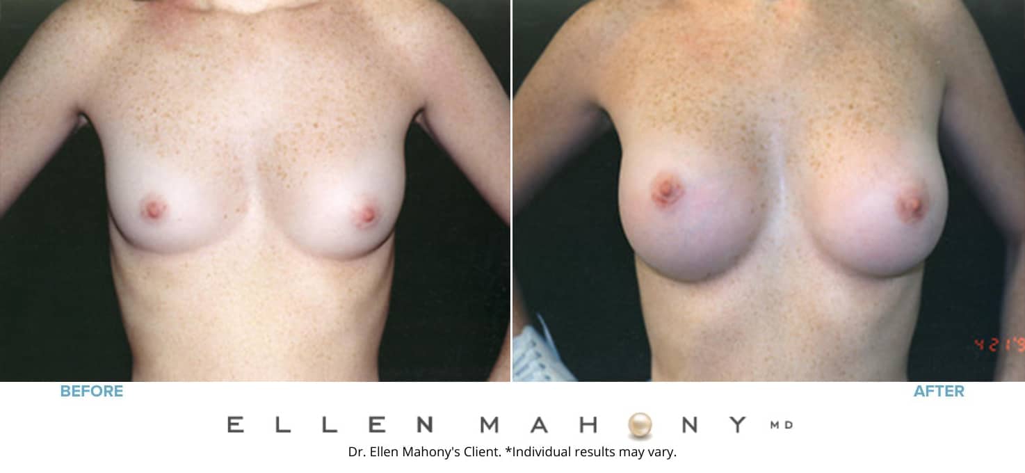 Before and After Image: Case #3188 - front