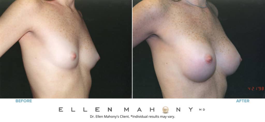 Before and After Image: Case #3188 - right-front-oblique
