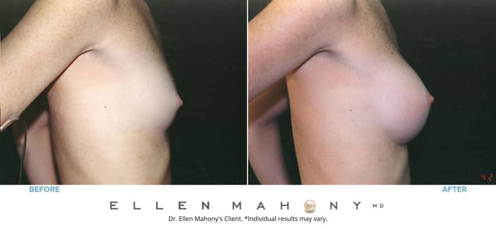 Before and After Image: Case #3188 - right-side