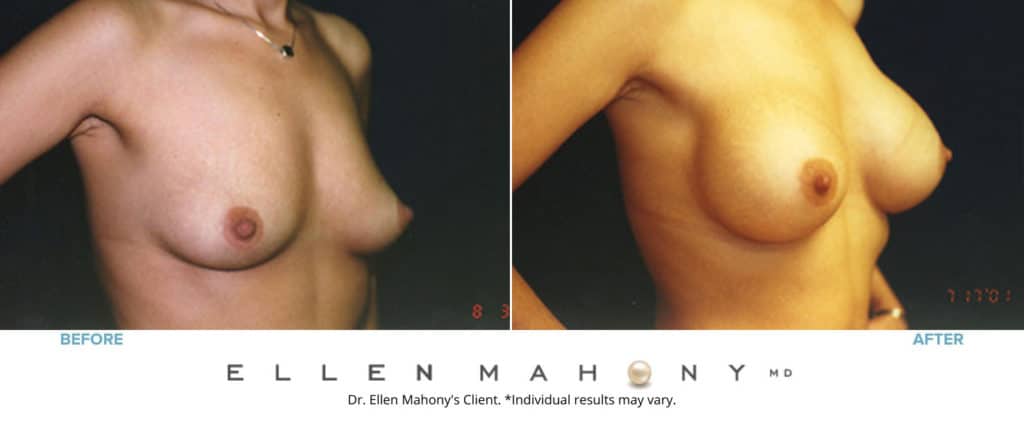 Before and After Image: Case #3195 - right-front-oblique