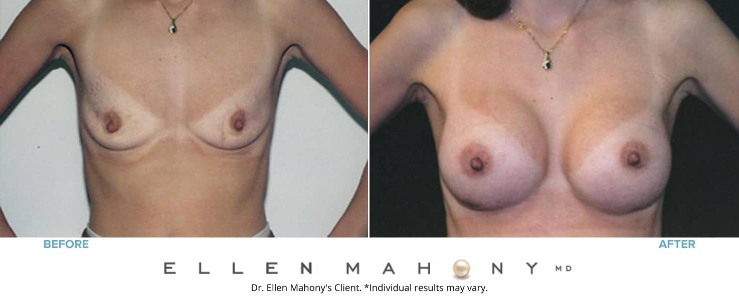 Before and After Image: Case #3202 - front