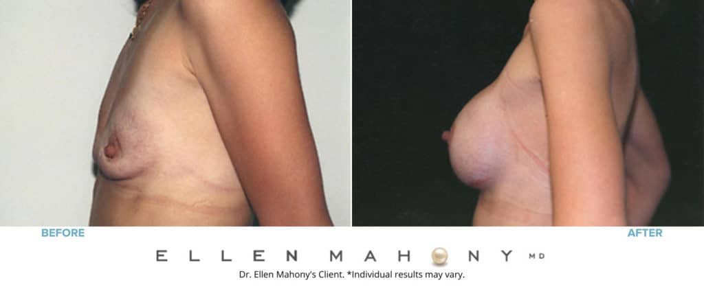 Before and After Image: Case #3202 - left-side