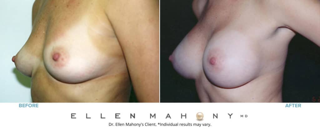 Before and After Image: Case #3209 - left-front-oblique