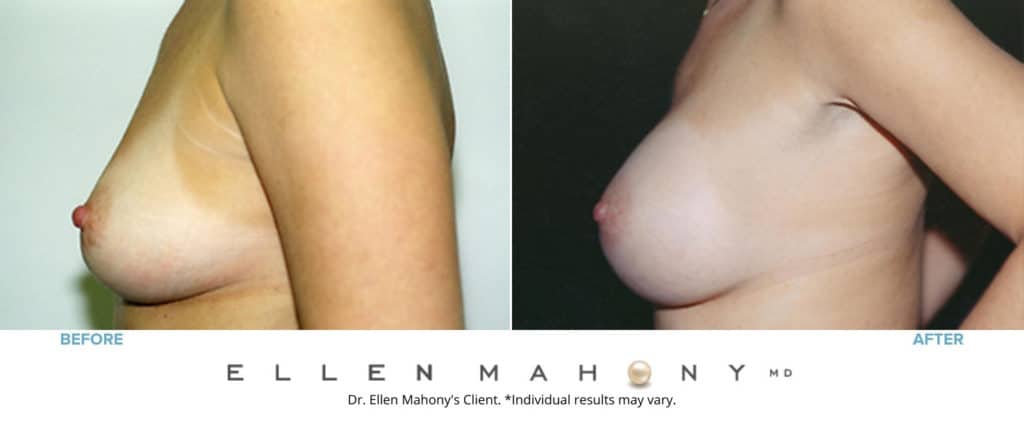 Before and After Image: Case #3209 - left-side