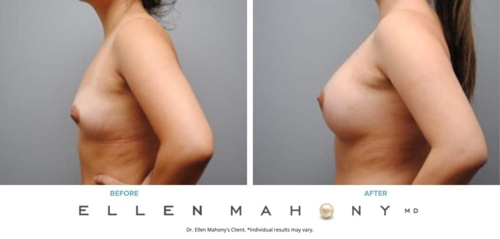 Before and After Image: Case #4806 - left-side