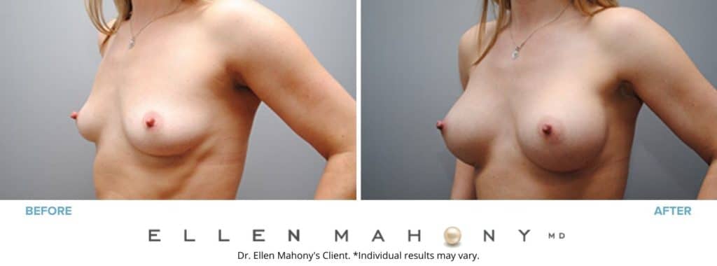 Before and After Image: Case #4854 - left-front-oblique