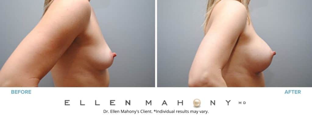 Before and After Image: Case #4854 - right-side