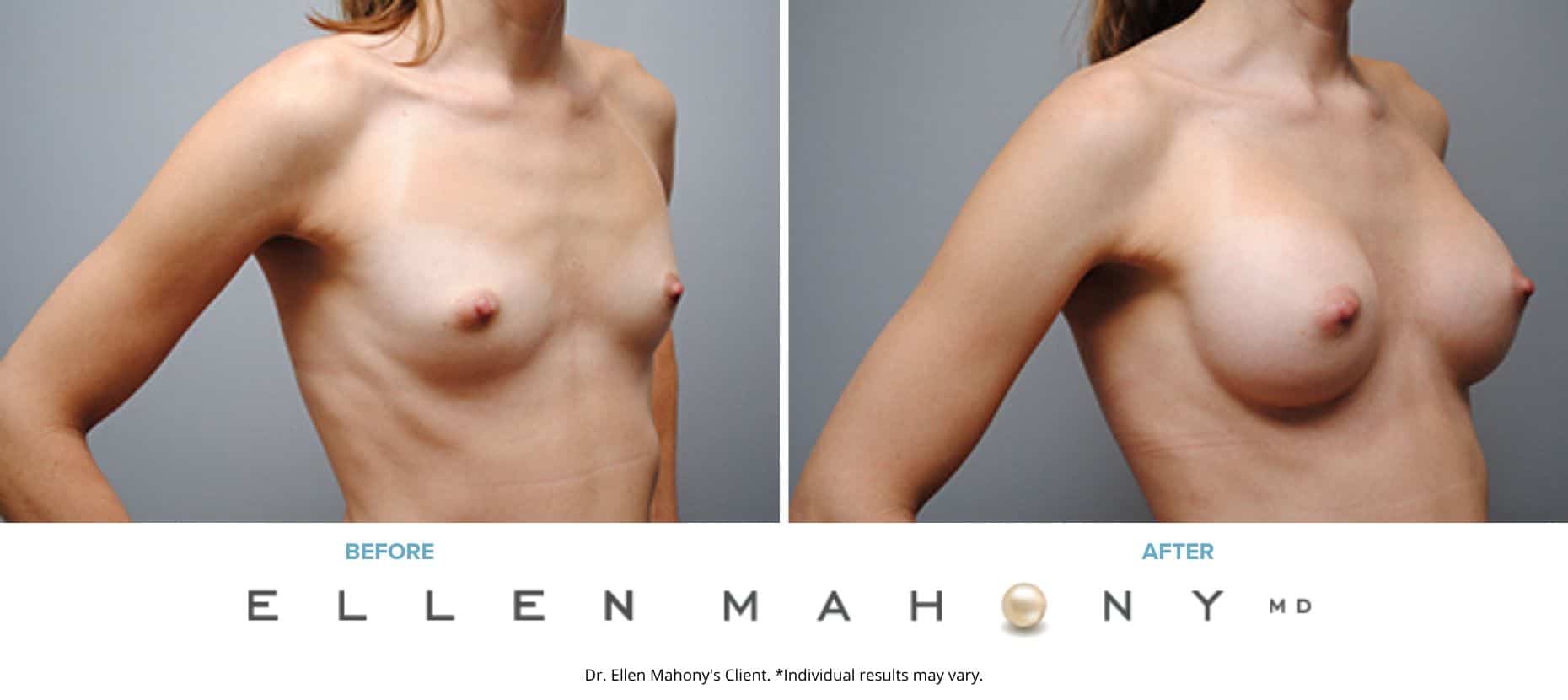 Before and After Image: Case #4937 - right-front-oblique