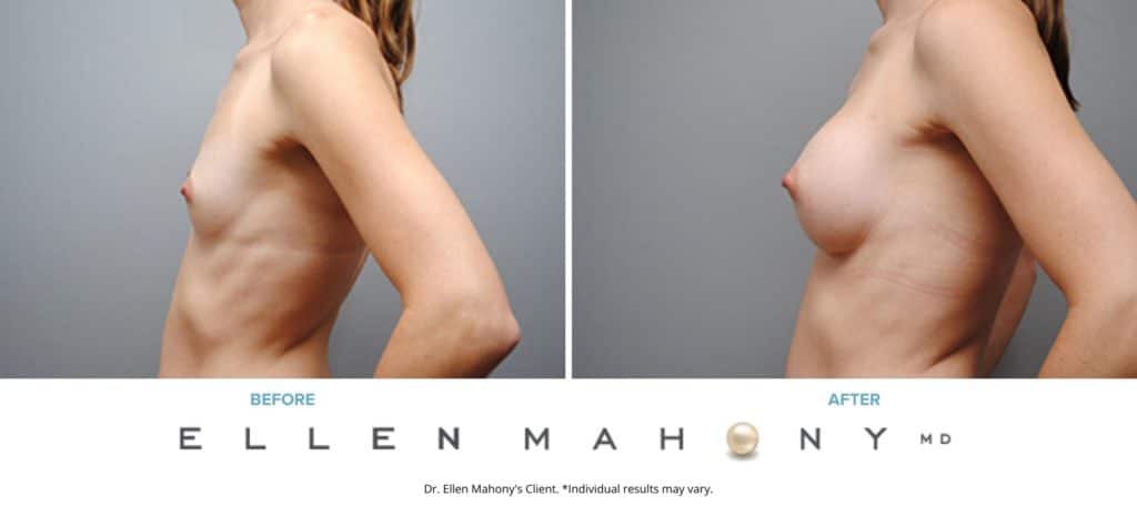 Before and After Image: Case #4937 - left-side