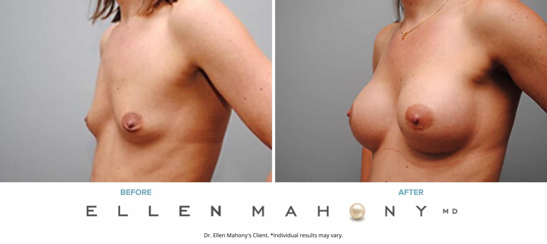 Before and After Image: Case #5011 - left-front-oblique