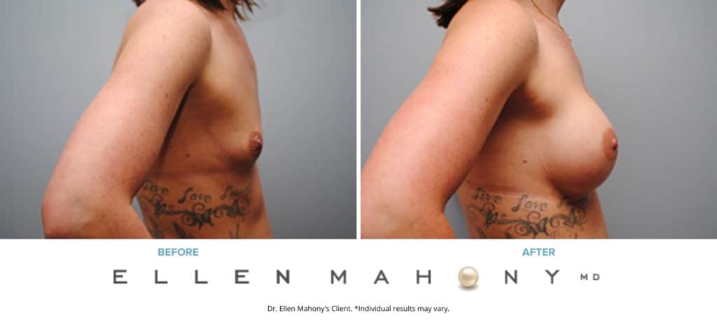 Before and After Image: Case #5011 - right-side