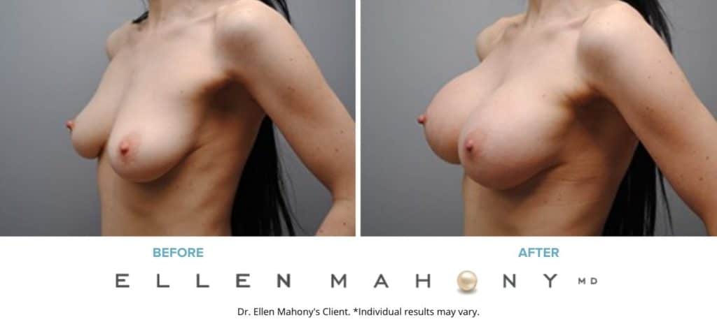 Before and After Image: Case #5094 - left-front-oblique