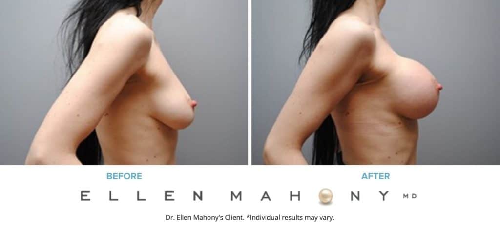 Before and After Image: Case #5094 - right-side