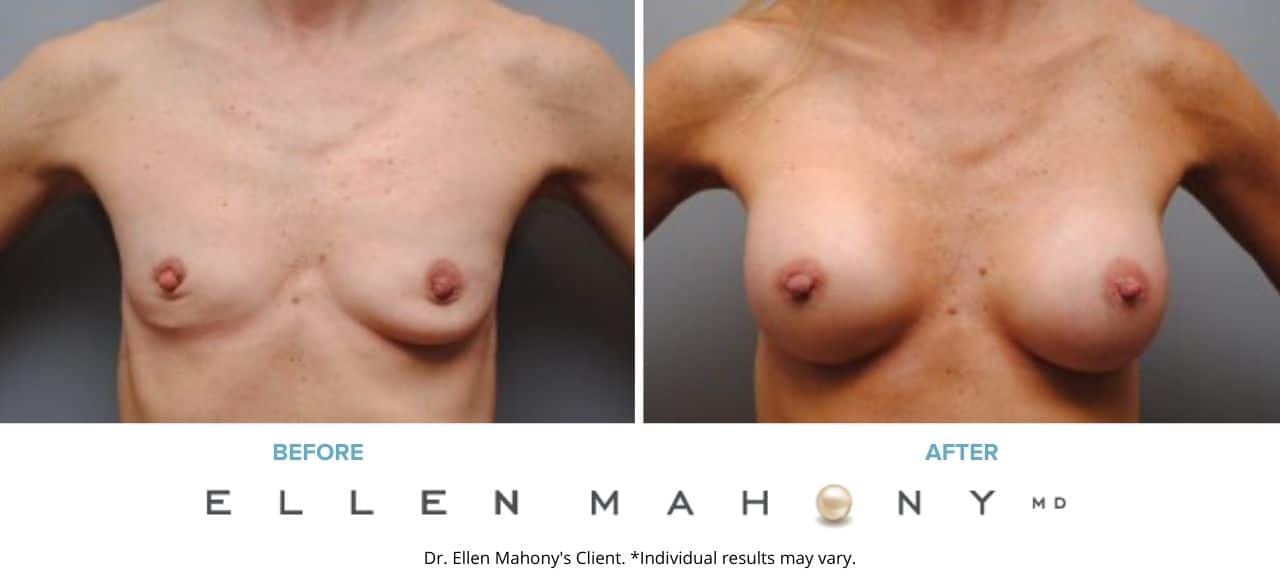 Before and After Image: Case #5395 - front