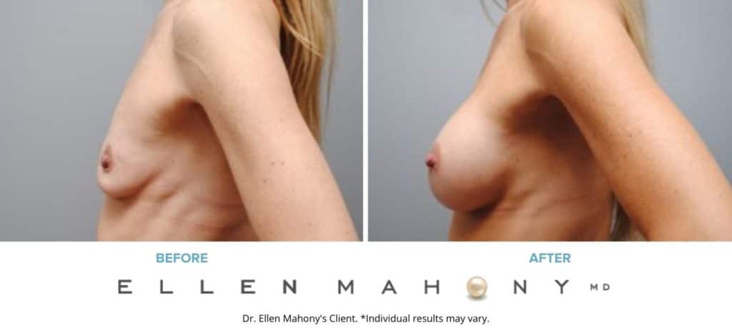Before and After Image: Case #5395 - left-side
