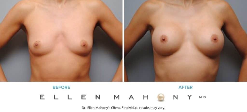 Before and After Image: Case #5405 - front