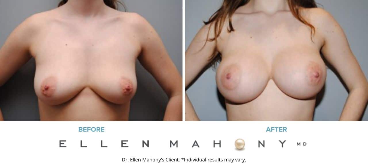 Before and After Image: Case #5491 - front