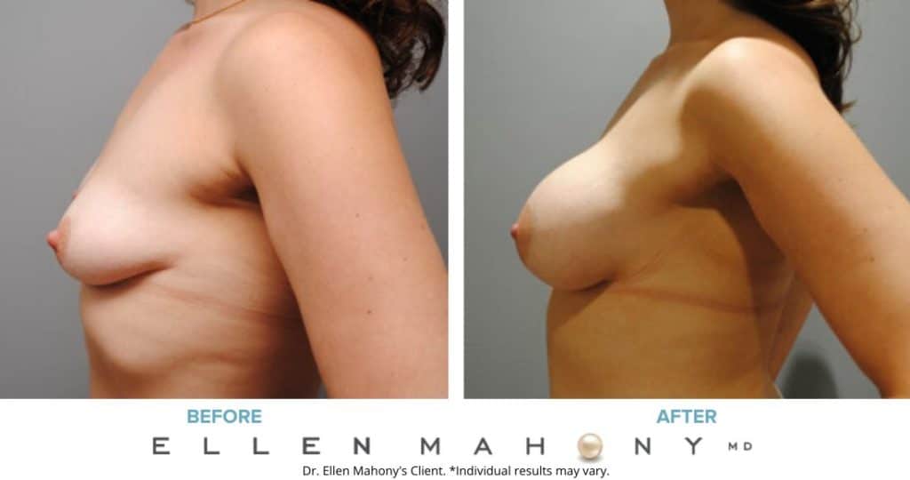 Before and After Image: Case #5954 - left-side