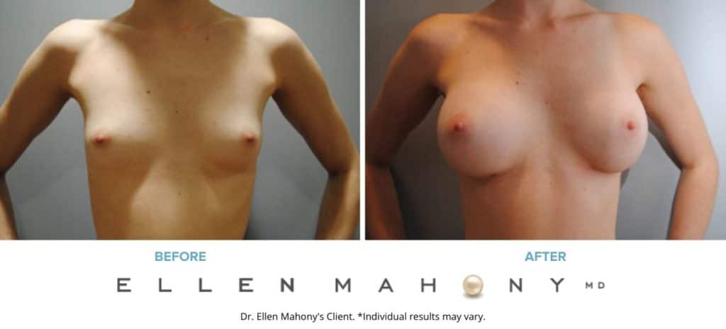 Before and After Image: Case #6078 - front