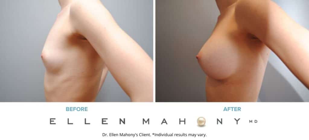 Before and After Image: Case #6078 - left-side
