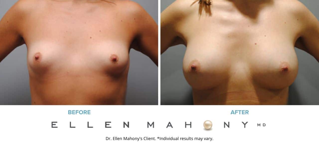 Before and After Image: Case #6103 - front